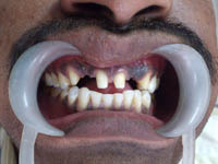 before dental treatment